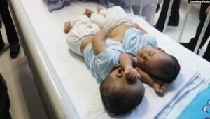 Adam dan Malik, Bayi Kembar Siam asal Medan Berhasil Dipisahkan tepat di Hari Anak Nasional