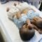 Bayi Kembar Siam Berhasil Dipisahkan Tepat di Hari Anak Nasional