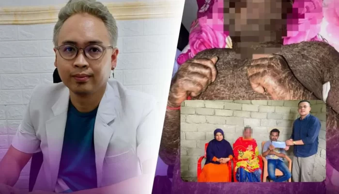 Pemuda Asal Sulawesi yang Sempat Viral Kulitnya Bersisik Usai Minum Collagen Pemutih, Ternyata Menderita Autoimun