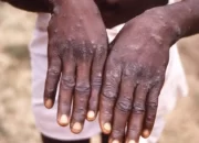 14 Kasus Cacar Monyet Ditemukan di Indonesia