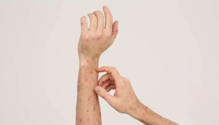 Dinkes Makassar Pastikan Tidak Ada Kasus Cacar Monyet di Kota Makassar